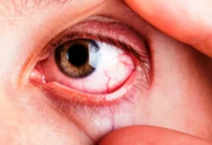 glaucoma, complicación de diabetes