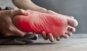 pie con neuropatia diabetica, diabetes