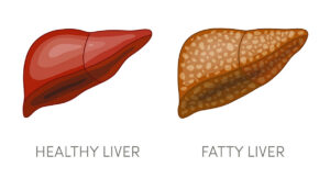 higado graso en dieta keto efectos adversos y contraindicaciones