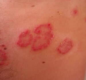 dermatitis por celiaquia
